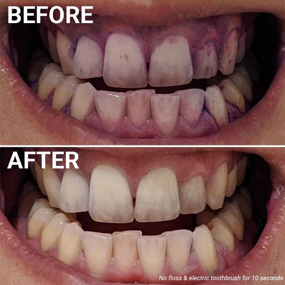 Before and after photos of plaque disclosing, having used an electric toothbrush for 10 seconds and not flossing afterwards