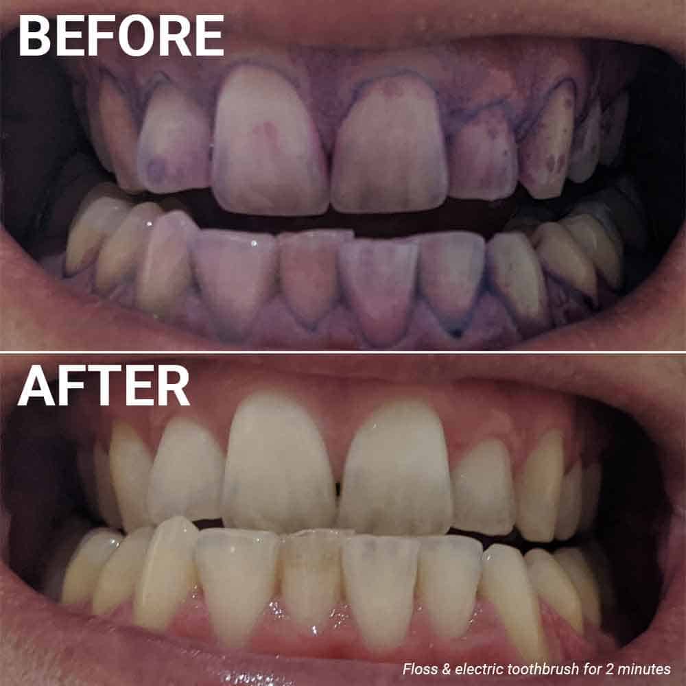 Before and after photos of plaque disclosing, having used an electric toothbrush 2 minutes and then flossing