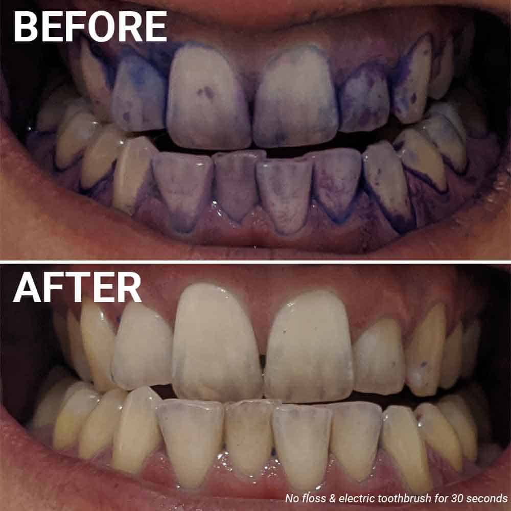 Before and after photos of plaque disclosing, having used an electric toothbrush for 30 seconds but not flossing
