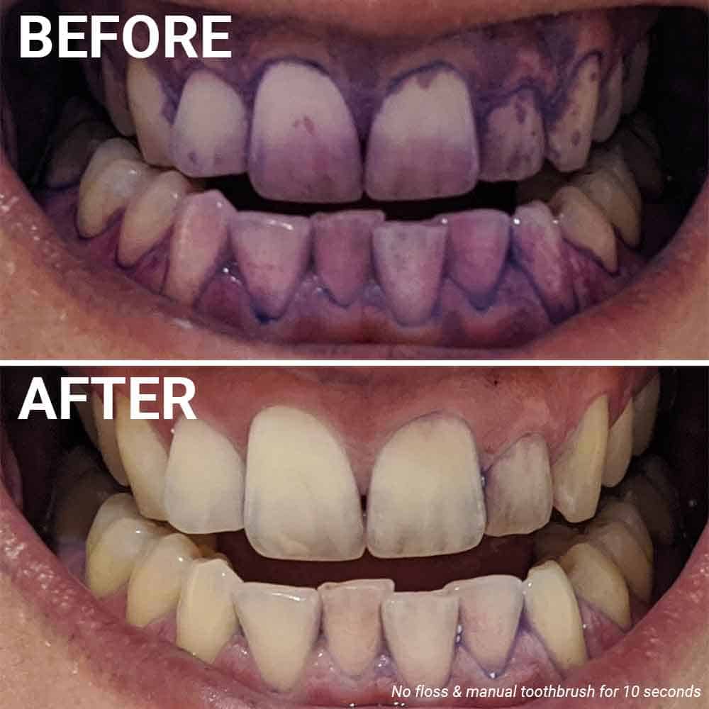 Before and after photos of plaque disclosing, having used a manual toothbrush for 10 seconds and no flossing