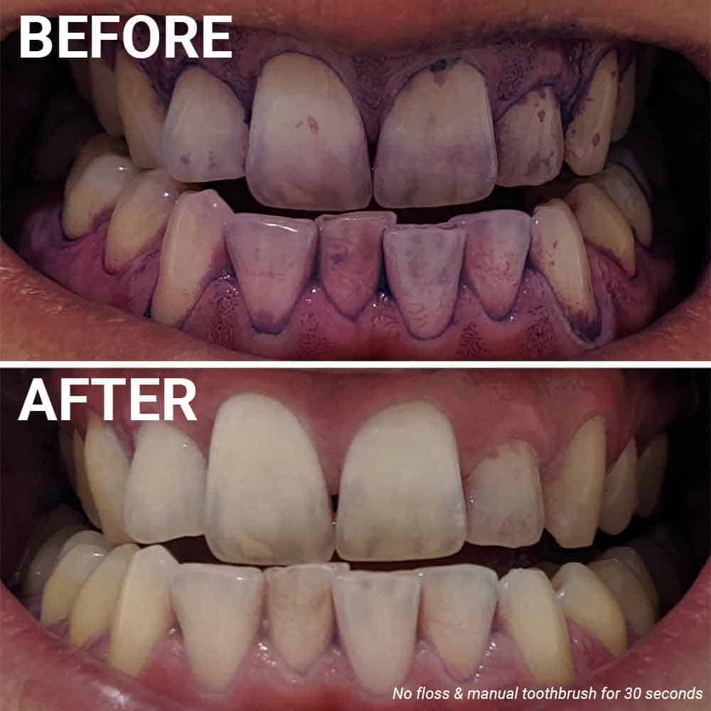 Before and after photos of plaque disclosing, having used a manual toothbrush for 30 seconds and not flossing