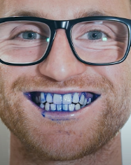 Man with plaque disclosing solution on his teeth
