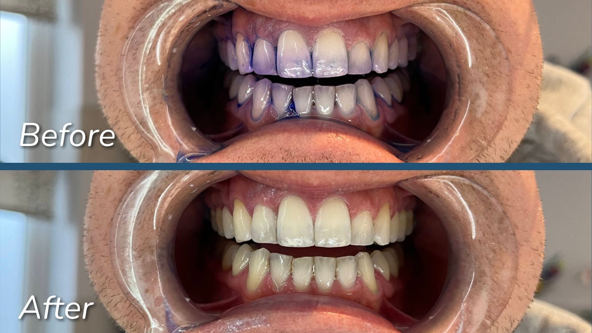 Sonicare Series 5500 Plaque disclosing test before and after