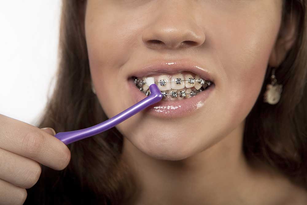 How to brush your teeth with braces 3