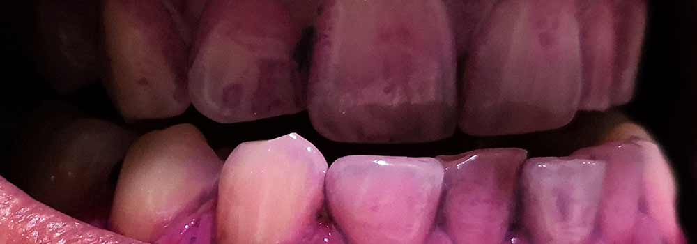 Gingivitis (Gum Disease): Symptoms, Causes, Treatments & FAQ. 19