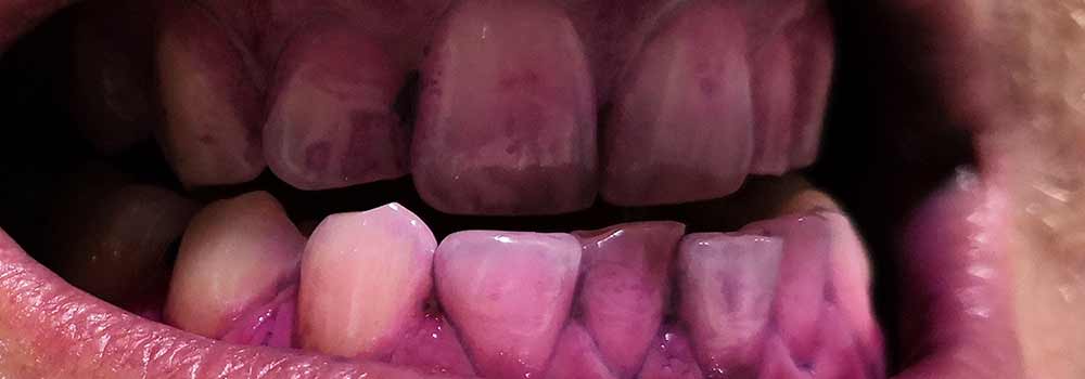 Close-up of teeth with plaque disclosing solution on them