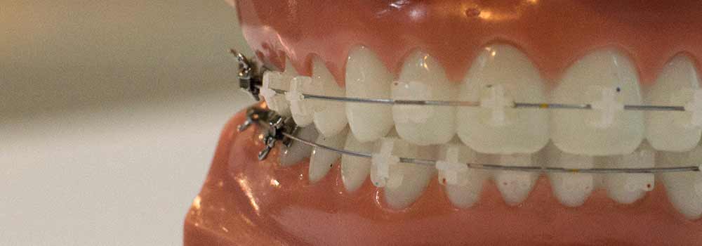 How to brush your teeth with braces 4