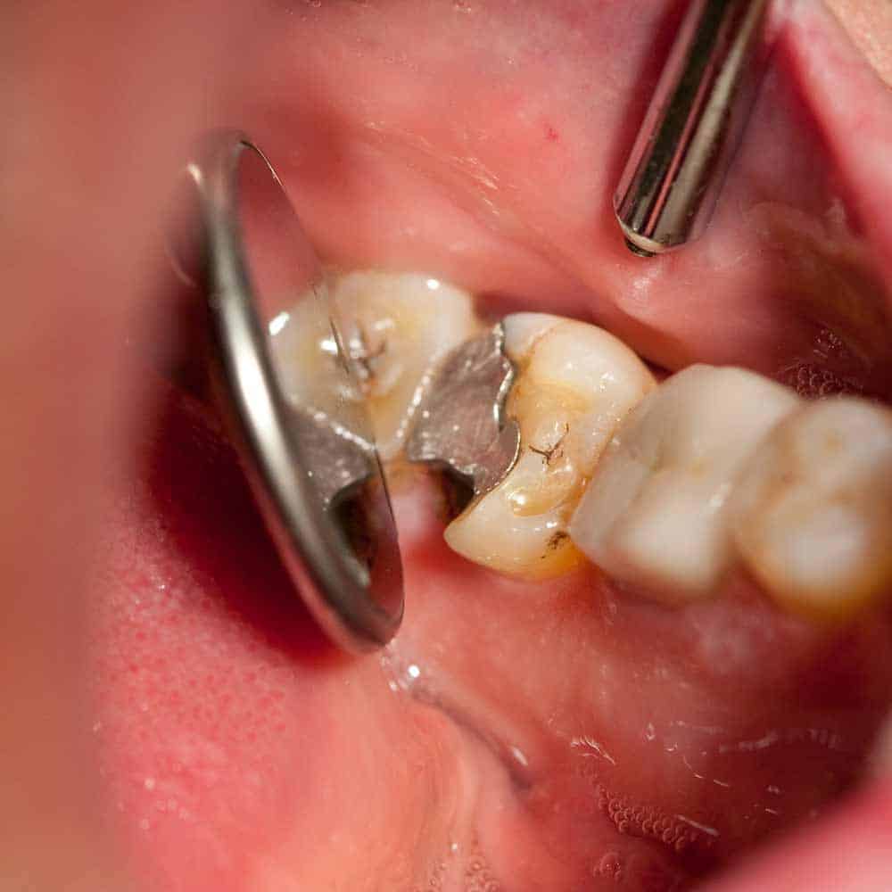 damaged tooth undergoing treatment