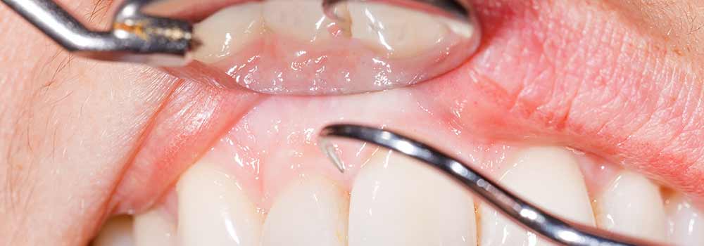 Tooth Extraction: Healing Time, Cost & Removal Process 2