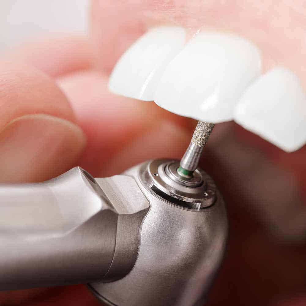 Do 'natural' teeth whitening methods work? 1