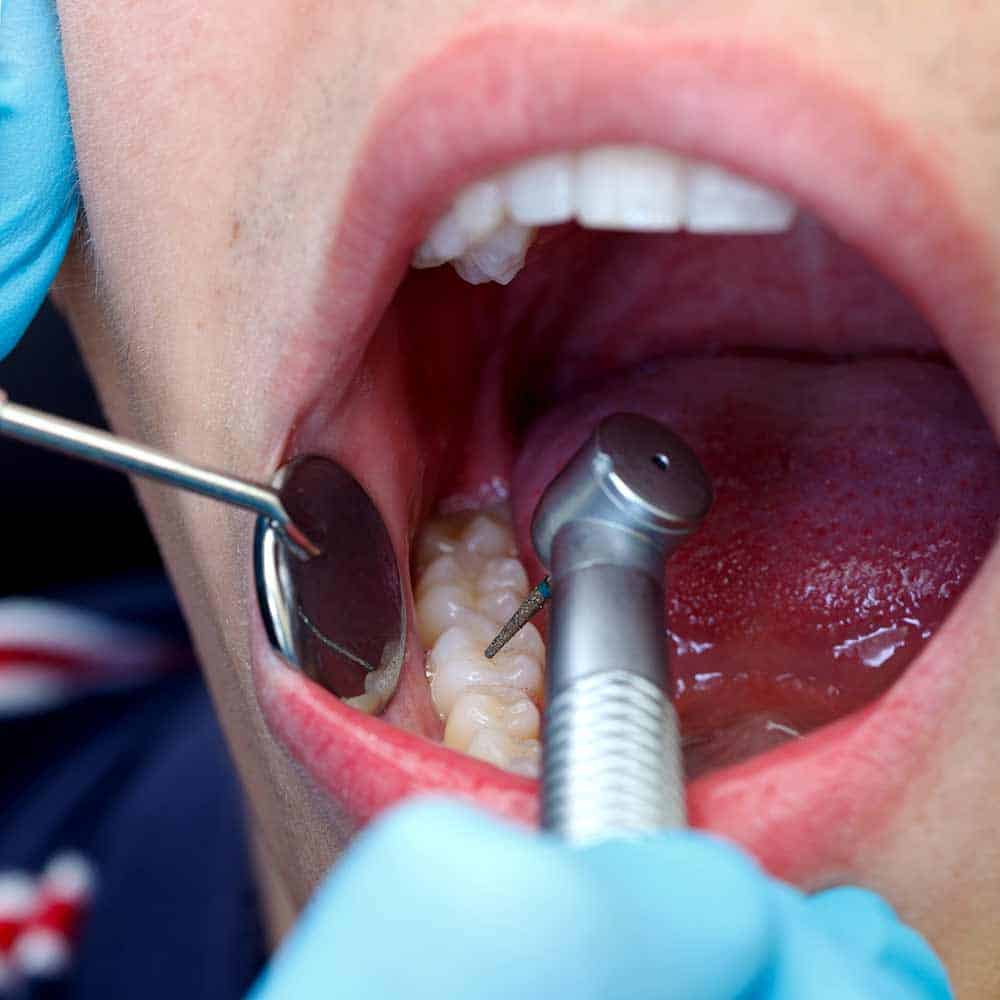 Dental Crowns & Tooth Caps: Costs, Procedure & FAQ 14