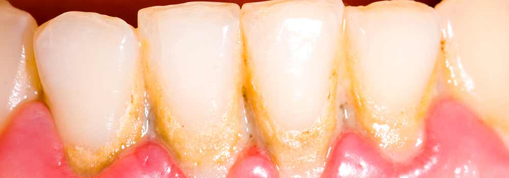 Bleeding gums when brushing teeth 7