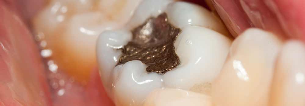 Close up of a tooth filling