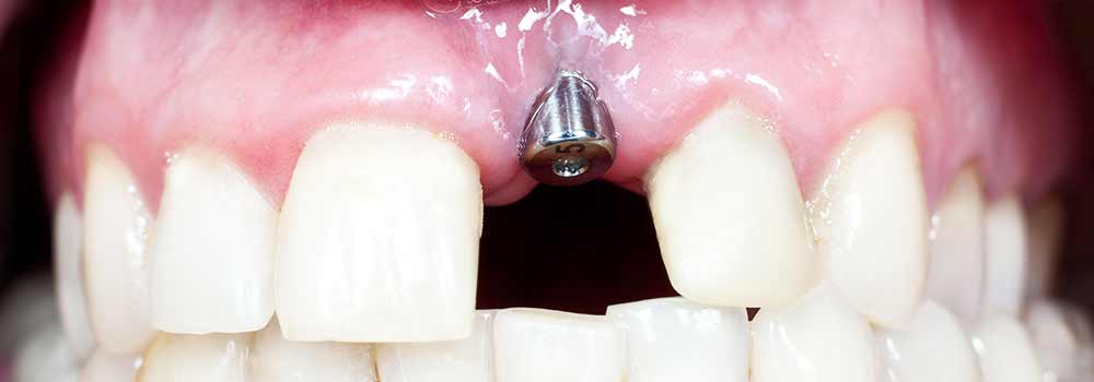 How much does a single tooth implant cost?