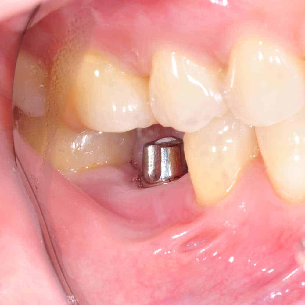 Implant in gum line