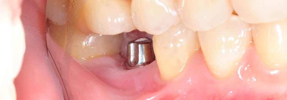 Photo of single implant 