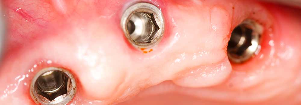 Denture Implants & Implant Retained Dentures: Procedure, Costs & FAQ 17
