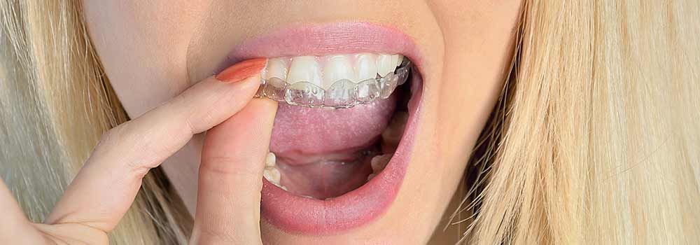 Professional Teeth Whitening: Costs, Advice & FAQ 3