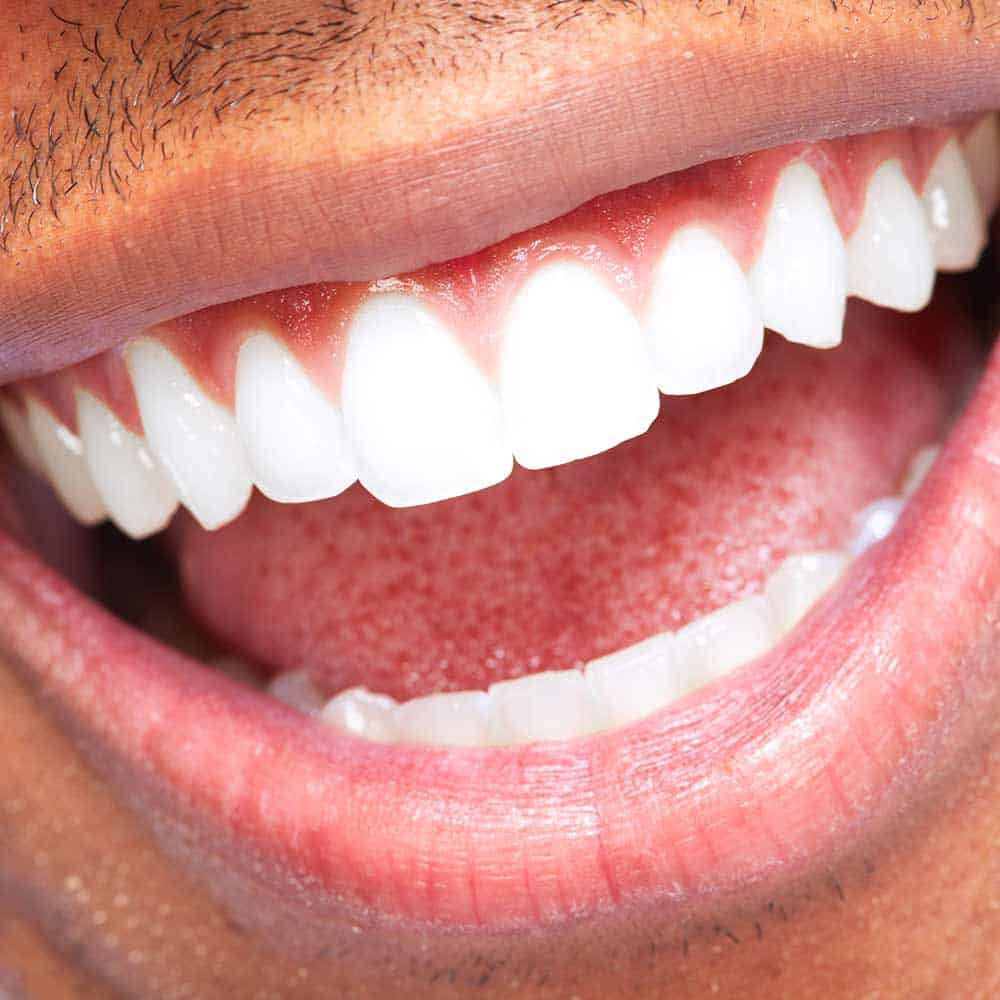 Bleeding gums when brushing teeth 16