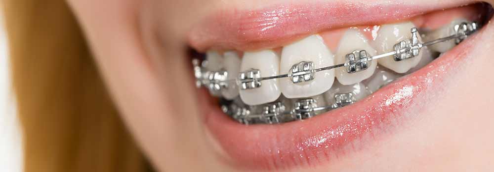 Smile with metal brace