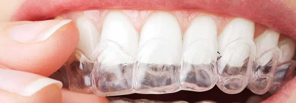 invisible brace on teeth