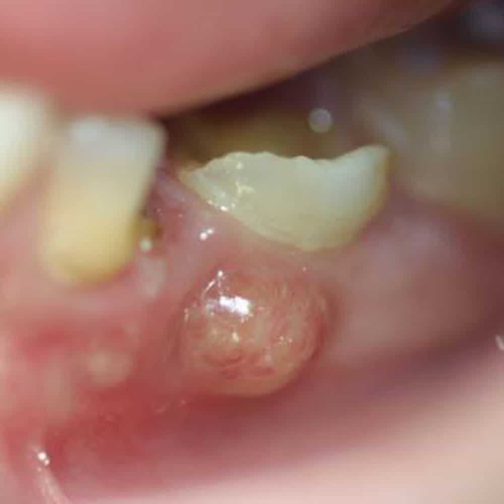 Tooth, mouth & gum abscess treatment: a detailed guide 10