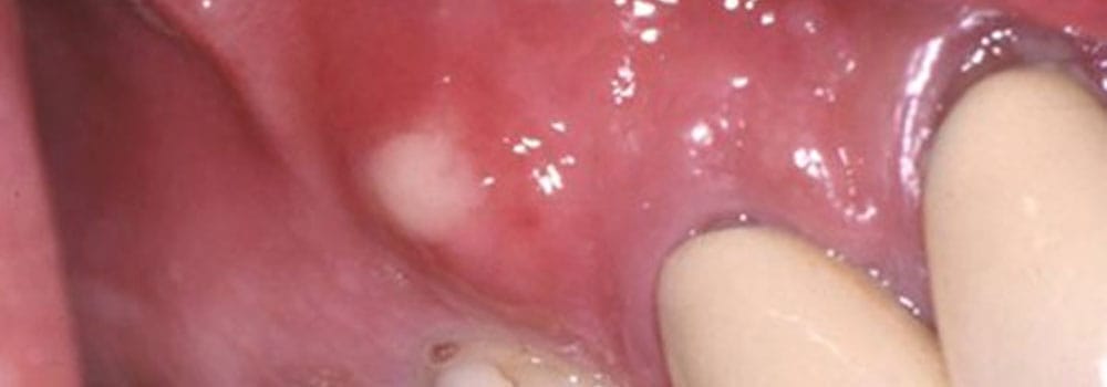 Tooth, mouth & gum abscess treatment: a detailed guide 1