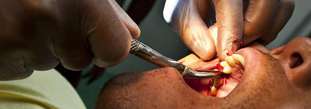Tooth Extraction: Healing Time, Cost & Removal Process 11