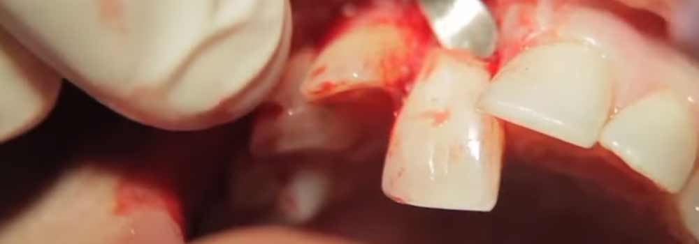 Tooth Extraction: Healing Time, Cost & Removal Process 13