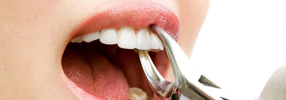 Tooth Extraction: Healing Time, Cost & Removal Process 1
