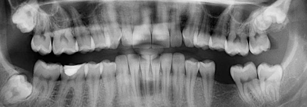 X-ray of a wisdom tooth