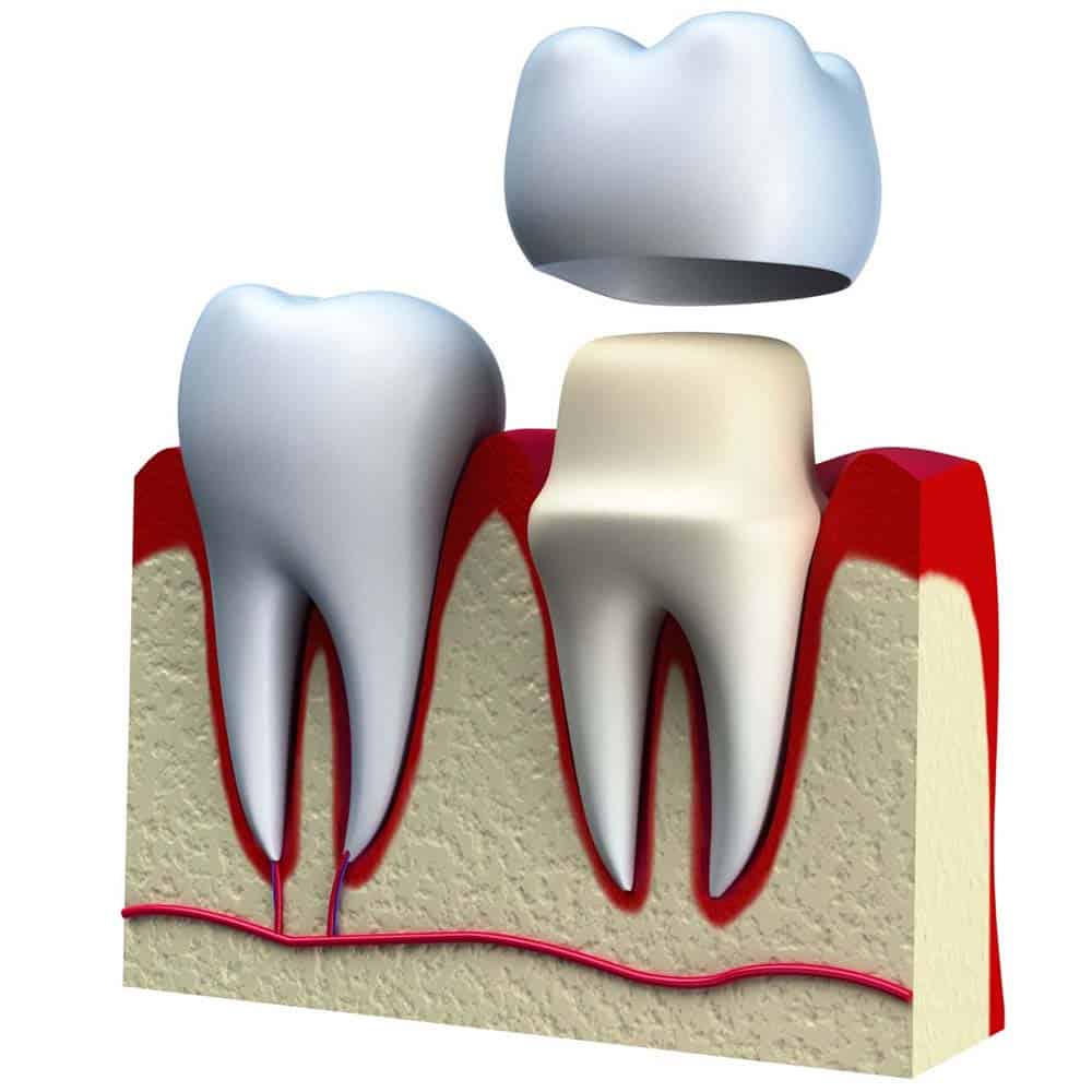 Dental Crowns & Tooth Caps: Costs, Procedure & FAQ 6