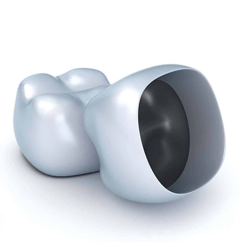 Dental Crowns & Tooth Caps: Costs, Procedure & FAQ 8