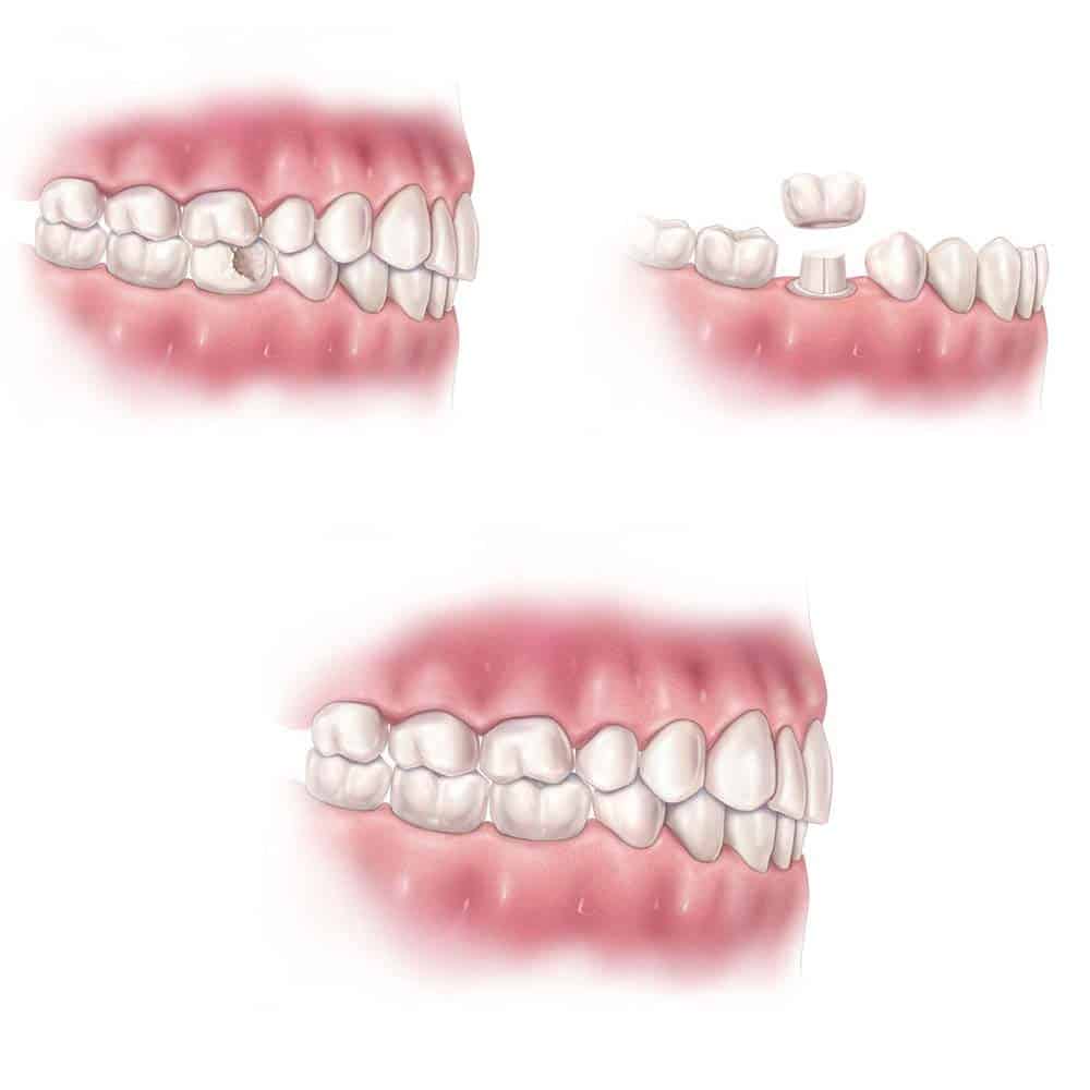 Dental Crowns & Tooth Caps: Costs, Procedure & FAQ 2
