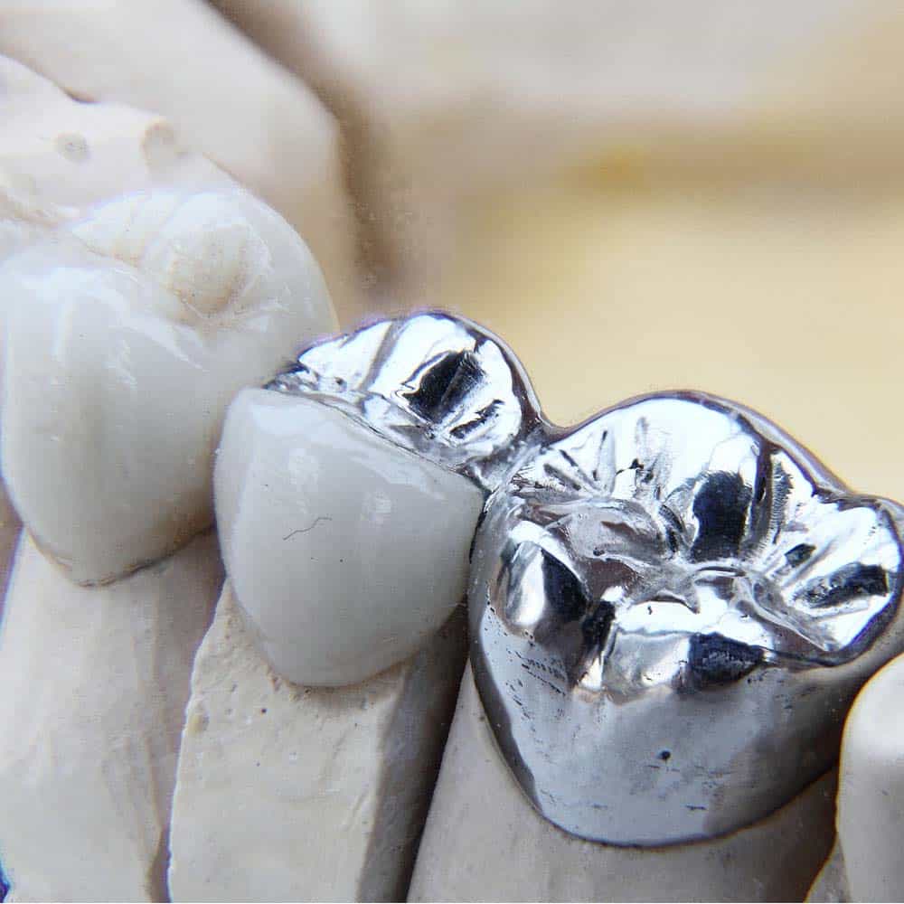 Dental Crowns & Tooth Caps: Costs, Procedure & FAQ 7
