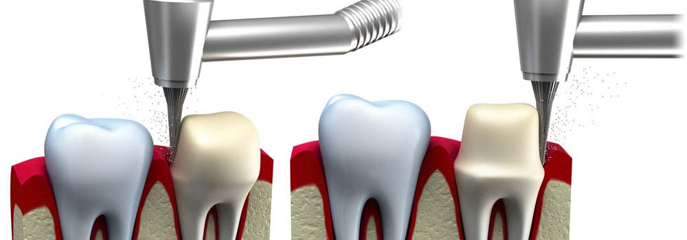 Dental Crowns & Tooth Caps: Costs, Procedure & FAQ 3