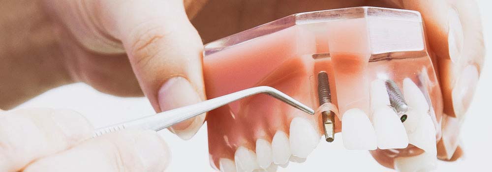 Dental Implants: Costs, Procedure & FAQ (UK) 10