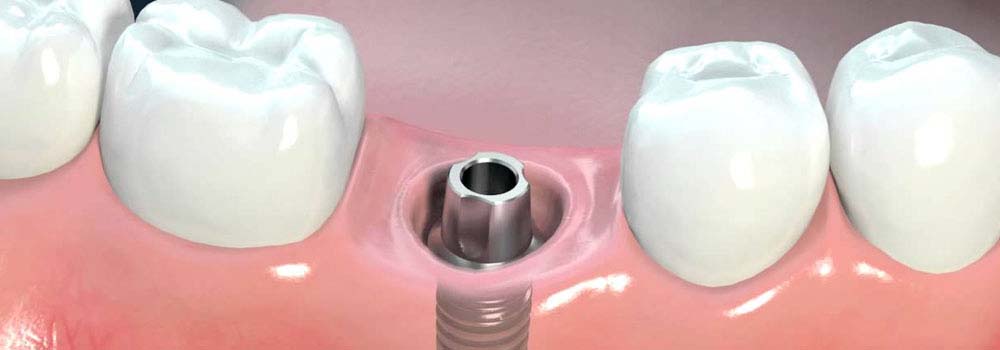 Dental Implants: Costs, Procedure & FAQ (UK) 26