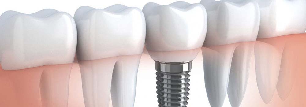 Dental Implants: Costs, Procedure & FAQ (UK) 9