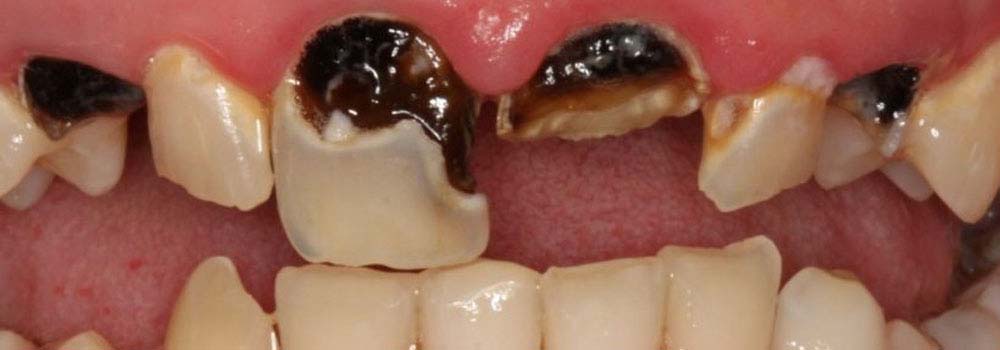 Multiple severe cavities of front teeth