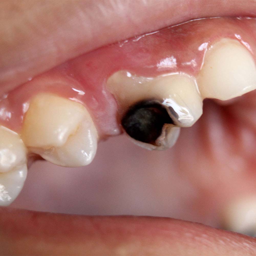 Decaying Tooth