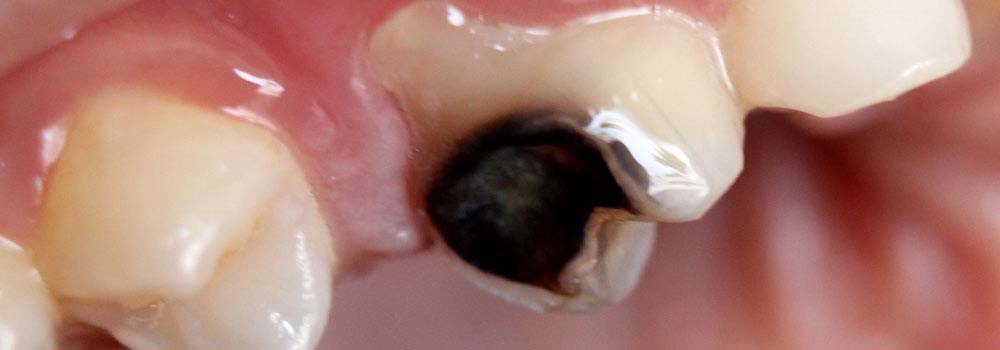 Close up of hole in tooth