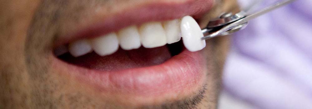 Snap On Veneers: Not The Best Way To Replace Missing Teeth 1
