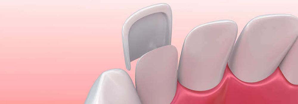 Illustration of veneers slotting over tooth