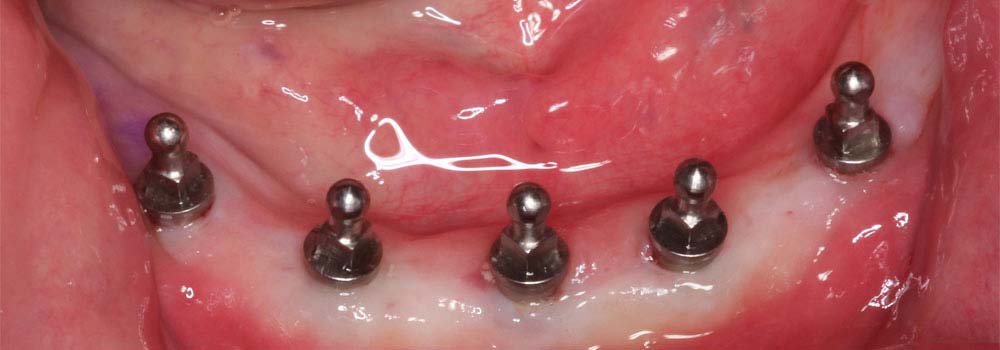 Close up photo of mini implants