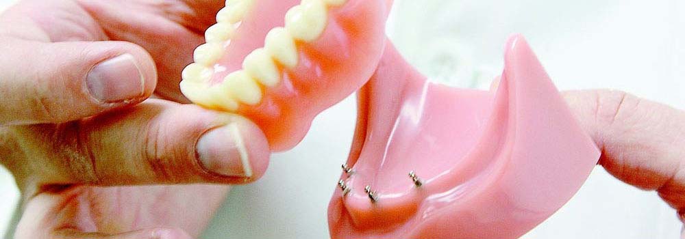 Model dentures being attached to implants