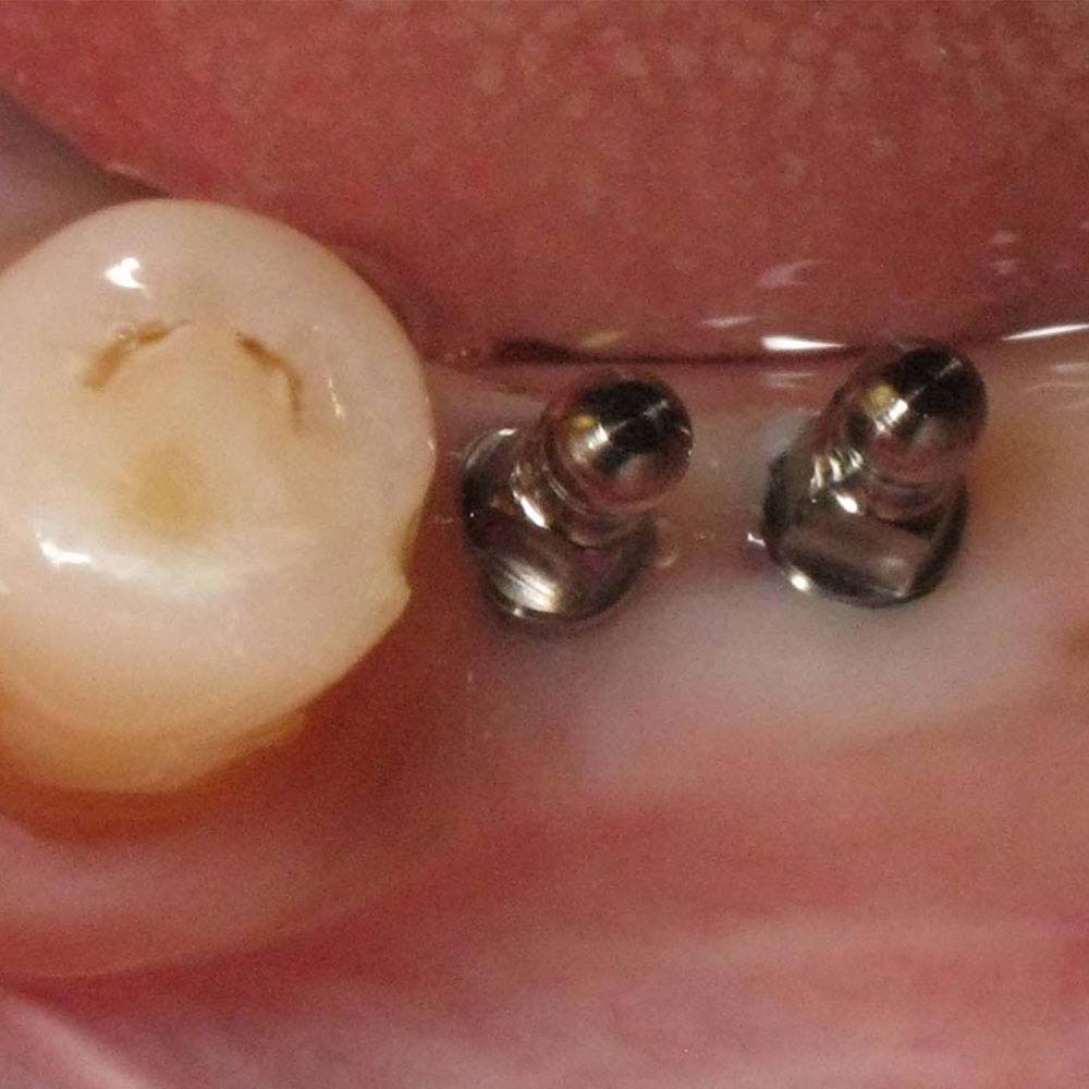 Mini & Midi Dental Implants: Costs, Procedure & FAQ 14