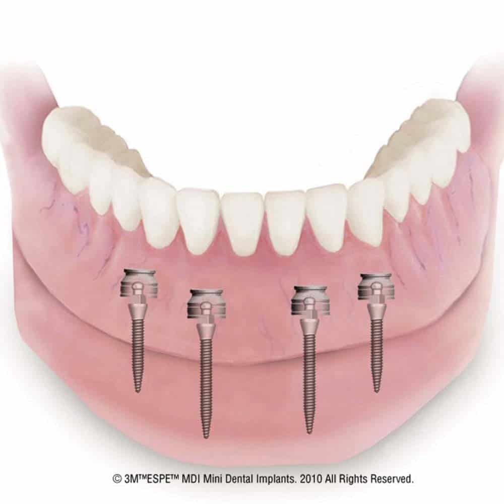 Mini & Midi Dental Implants: Costs, Procedure & FAQ 2