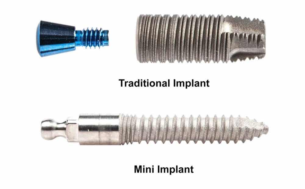 Traditional Implant vs Mini Implant