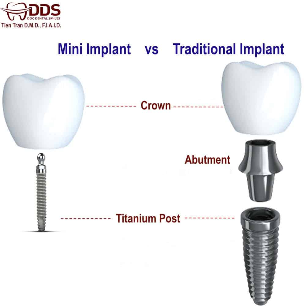 Mini & Midi Dental Implants: Costs, Procedure & FAQ 4